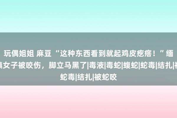 玩偶姐姐 麻豆 “这种东西看到就起鸡皮疙瘩！”缅甸小镇女子被咬伤，脚立马黑了|毒液|毒蛇|蝮蛇|蛇毒|结扎|被蛇咬